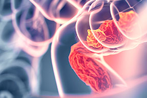 Cáncer colorrectal. Actualización y tendencias futuras
