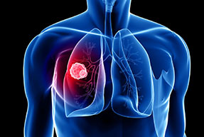 Cáncer de pulmón. Actualización y tendencias futuras